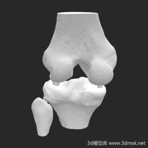 医疗膝关节3d打印模型下载